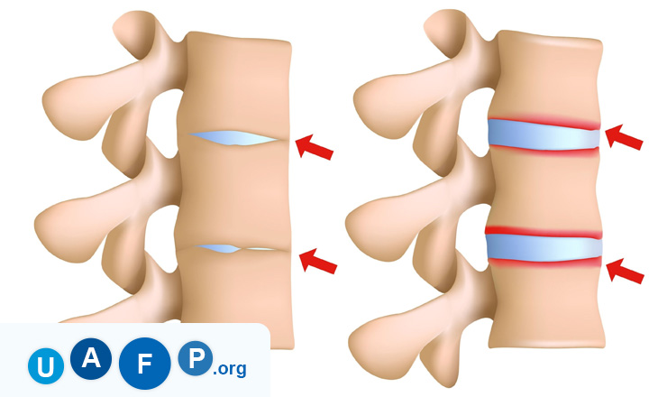 Ankylosing Spondylitis