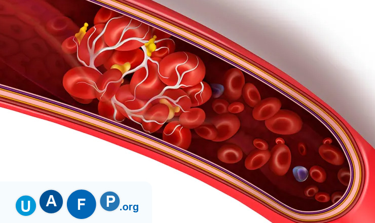 Blood Clots In Men