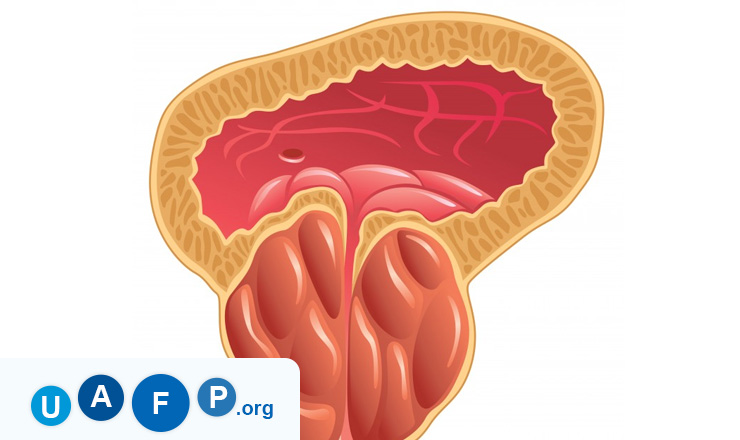 Benign Prostatic Hyperplasia