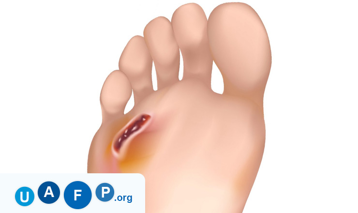 Diabetic Foot Ulcers