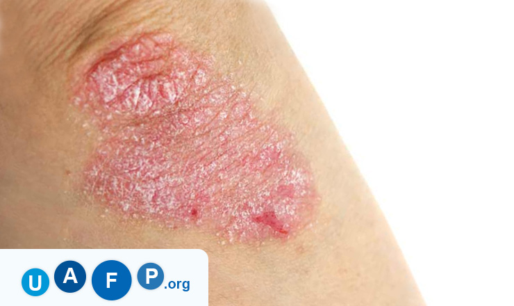 Eczema