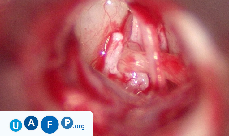 Fistula in Mouth